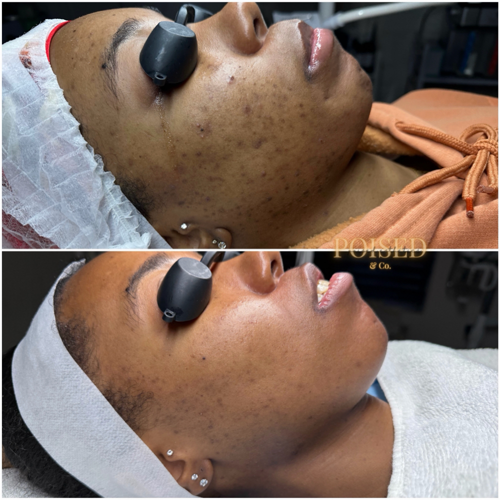 New Client- Pigment Correction at Poised Esthetics & Co. in Marietta, GA