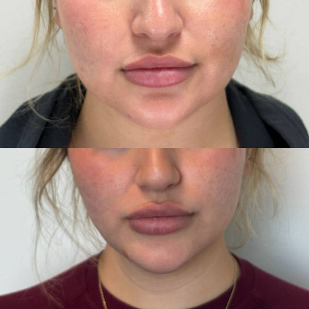 Face Slimming Tox (Masseter) at Lilli Aesthetics LLC in Mansfield, TX