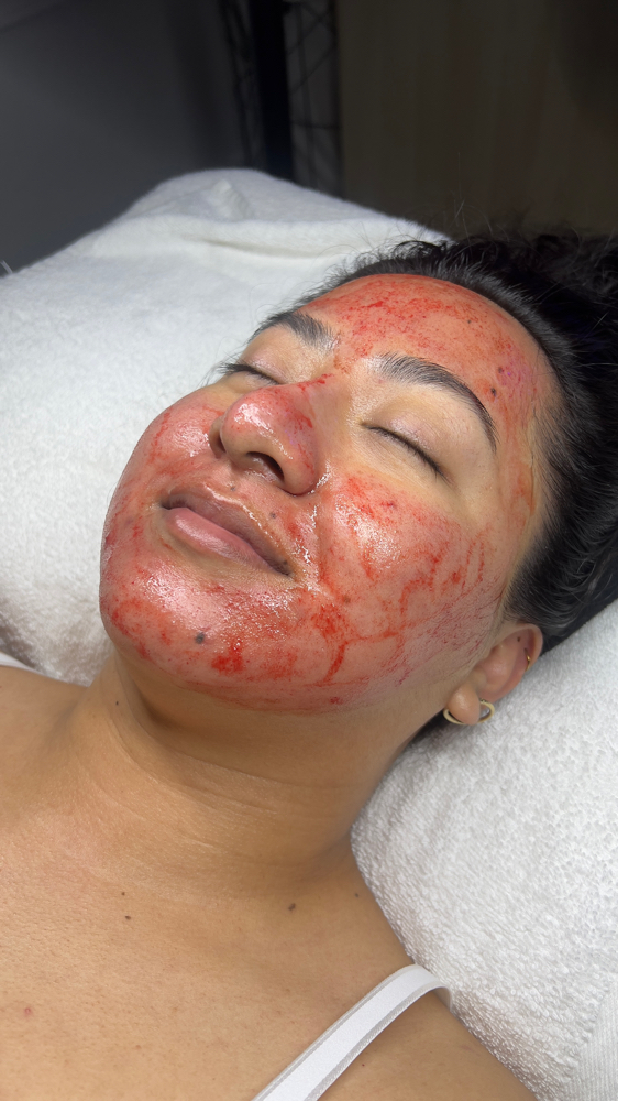 MICRO-NEEDLING