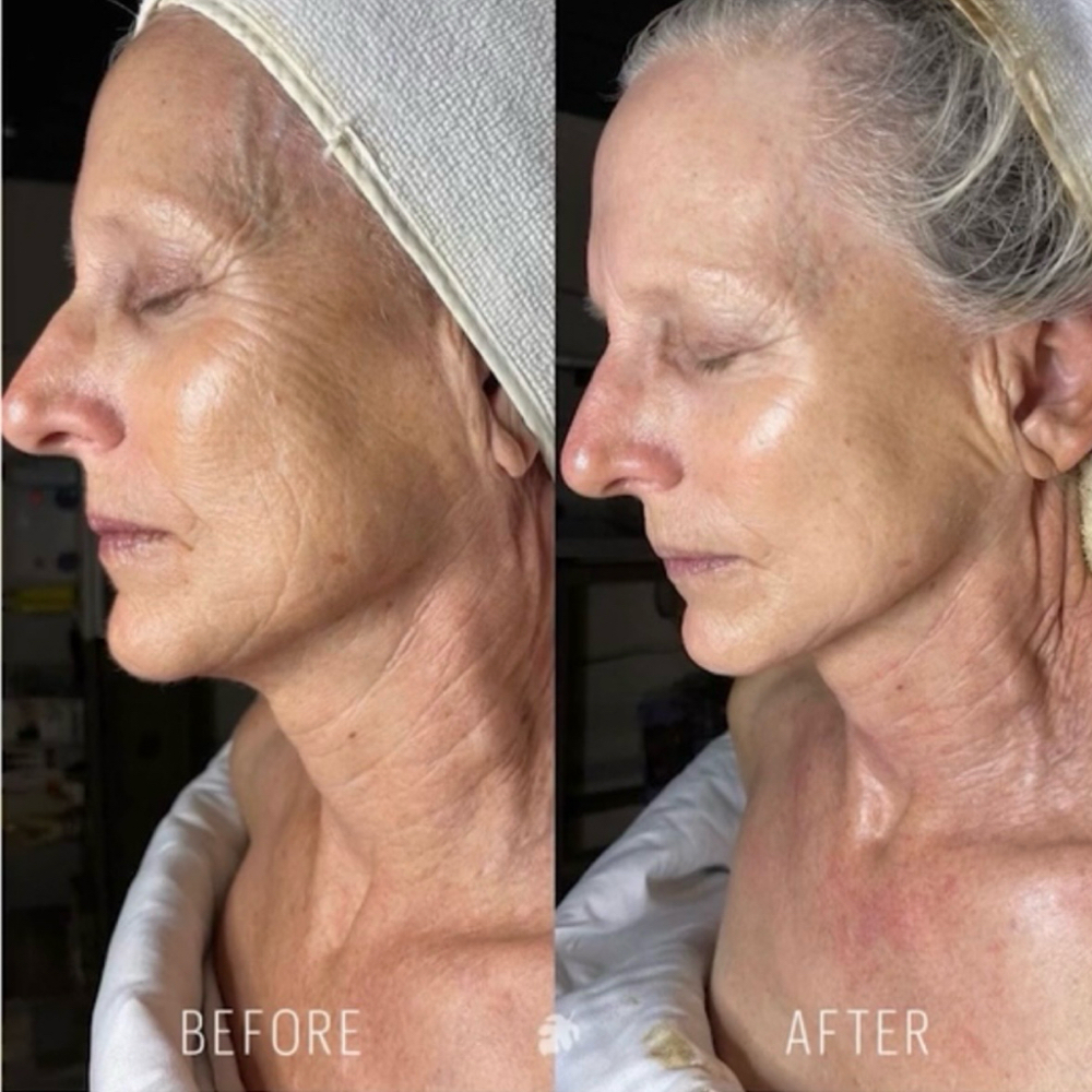 DMK 50 Day StemZyme® Program