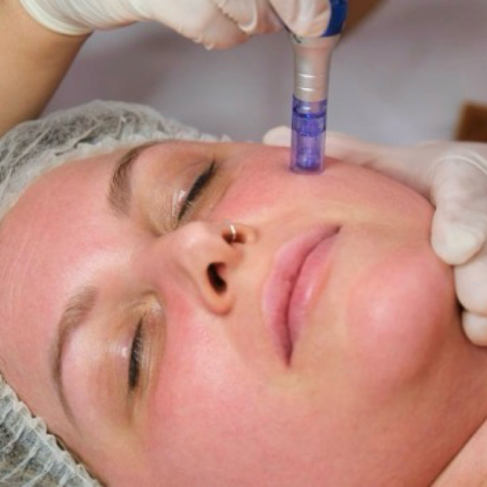 Microneedling Express Treatment at Essential Esthetics Spa, LLC in Parker, CO