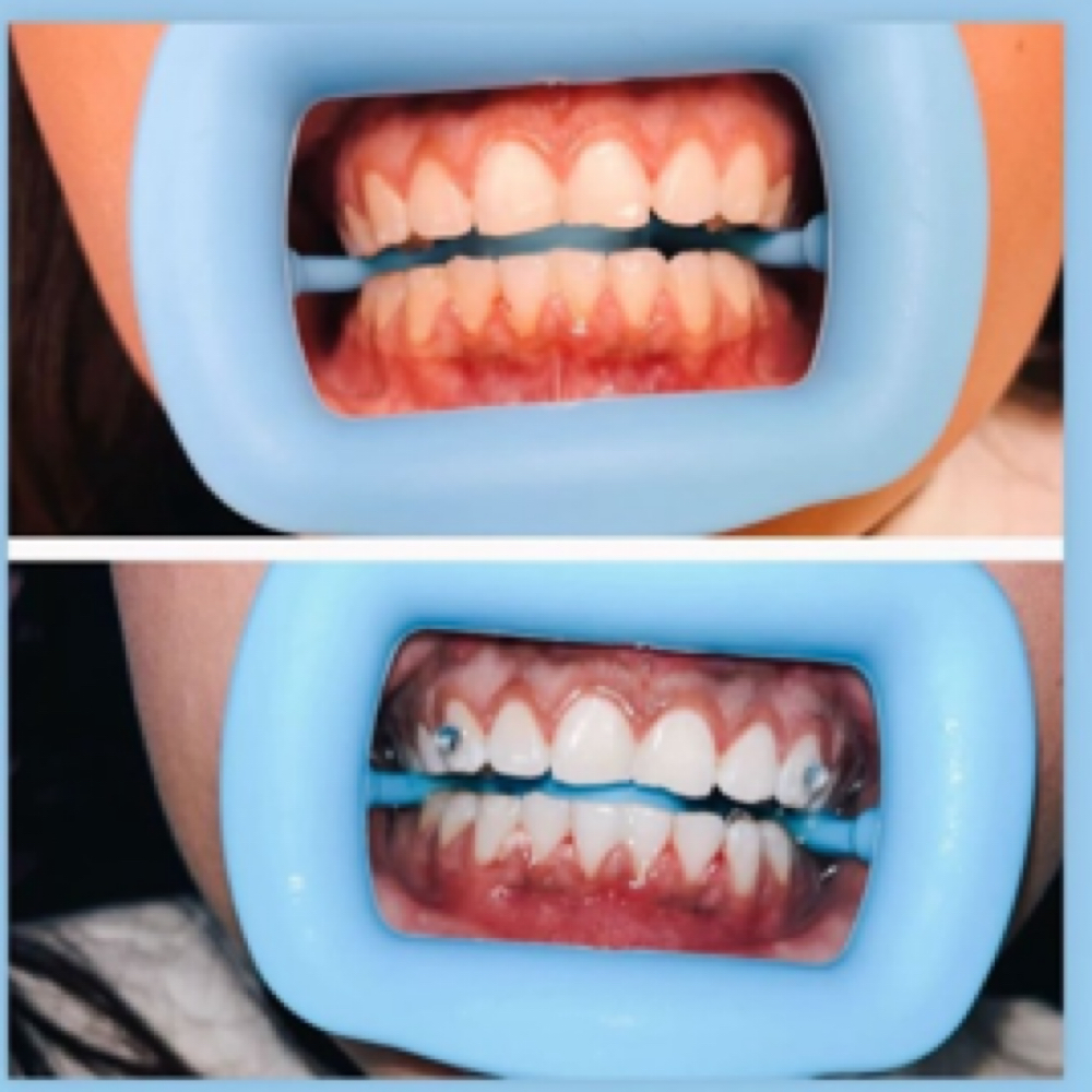 Professional Teeth Whitening at Ikonic Aesthetic Lounge in Asheboro, NC