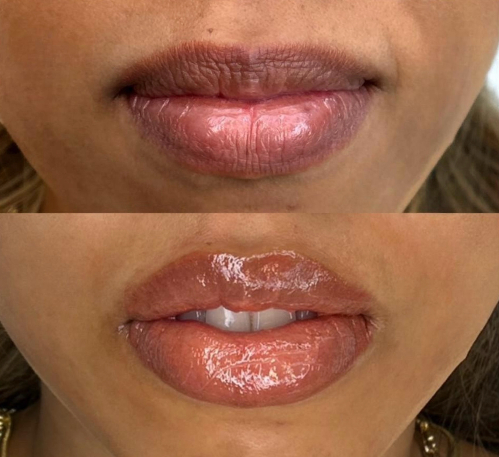 Lip Neutralization