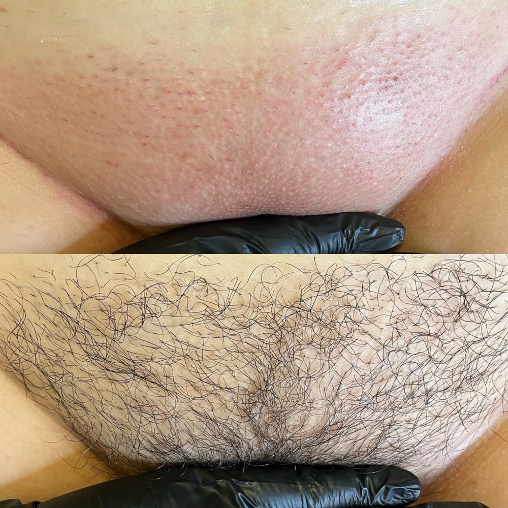 Brazilian Wax