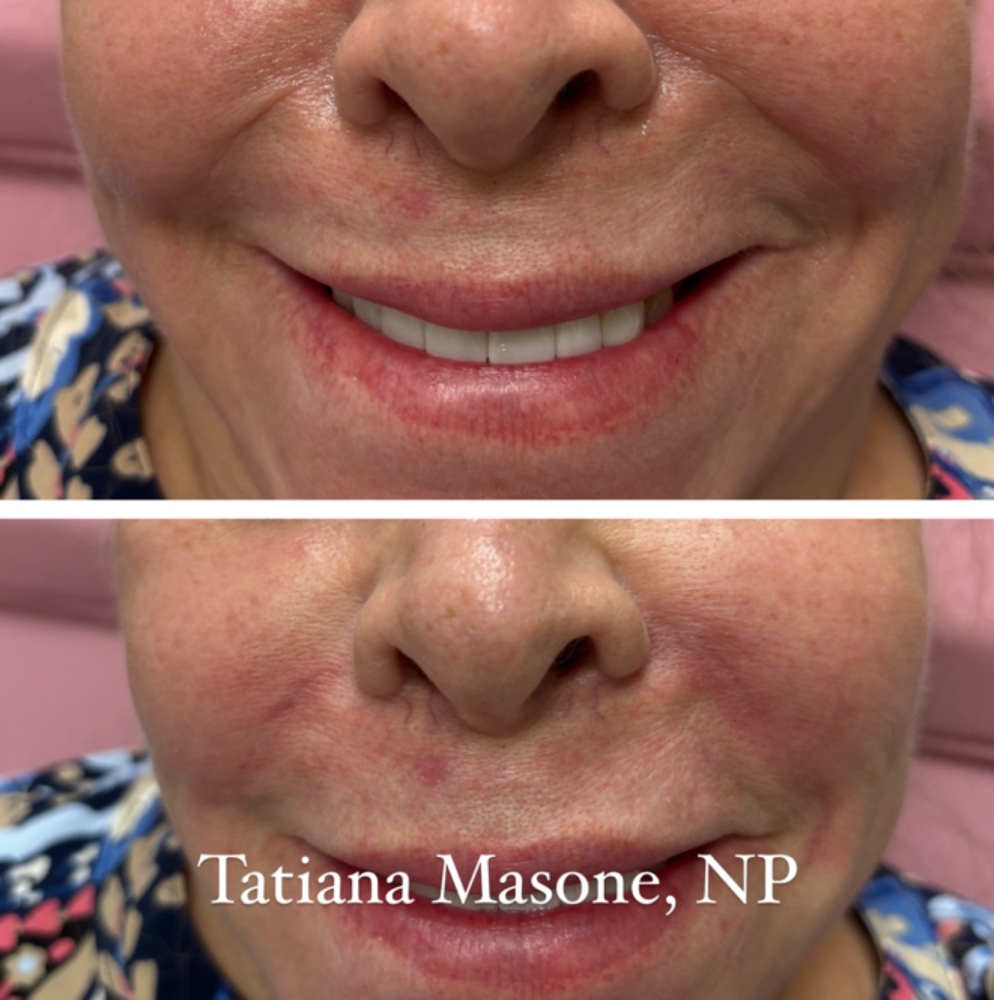 Nasolabial (Smile Line) Filler