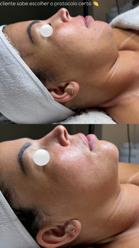 Pacote Renovação Total – HIFU + Mic at Jessica Luchesi Skin Wellness in Elizabeth, NJ