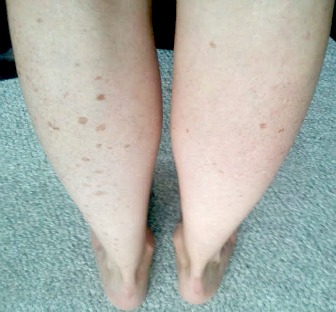 IPL/Photo Rejuvenation / Half Leg