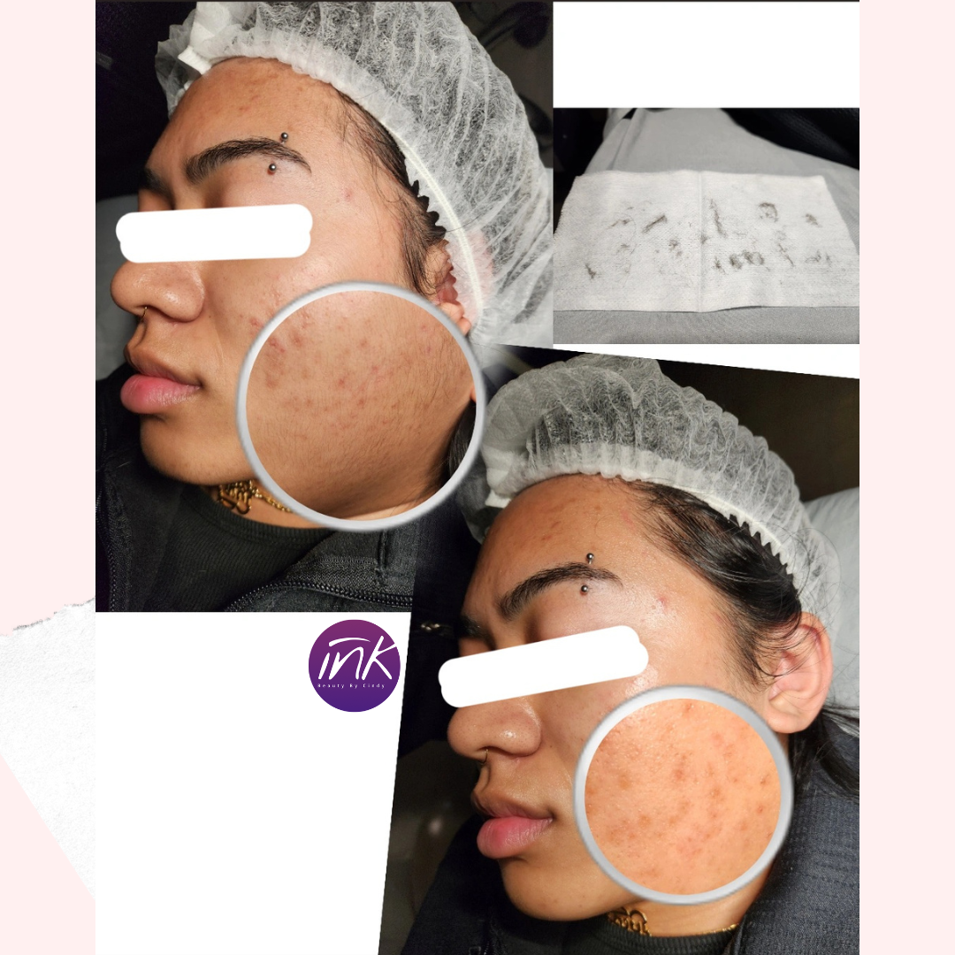 Facial Add-On Dermaplaning at I.S Beauty Studio in Cumming, GA
