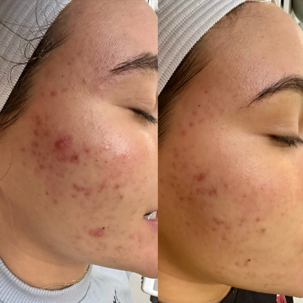 New Client Acne Treatment +Consult at Skin Guru LA in Cerritos, CA