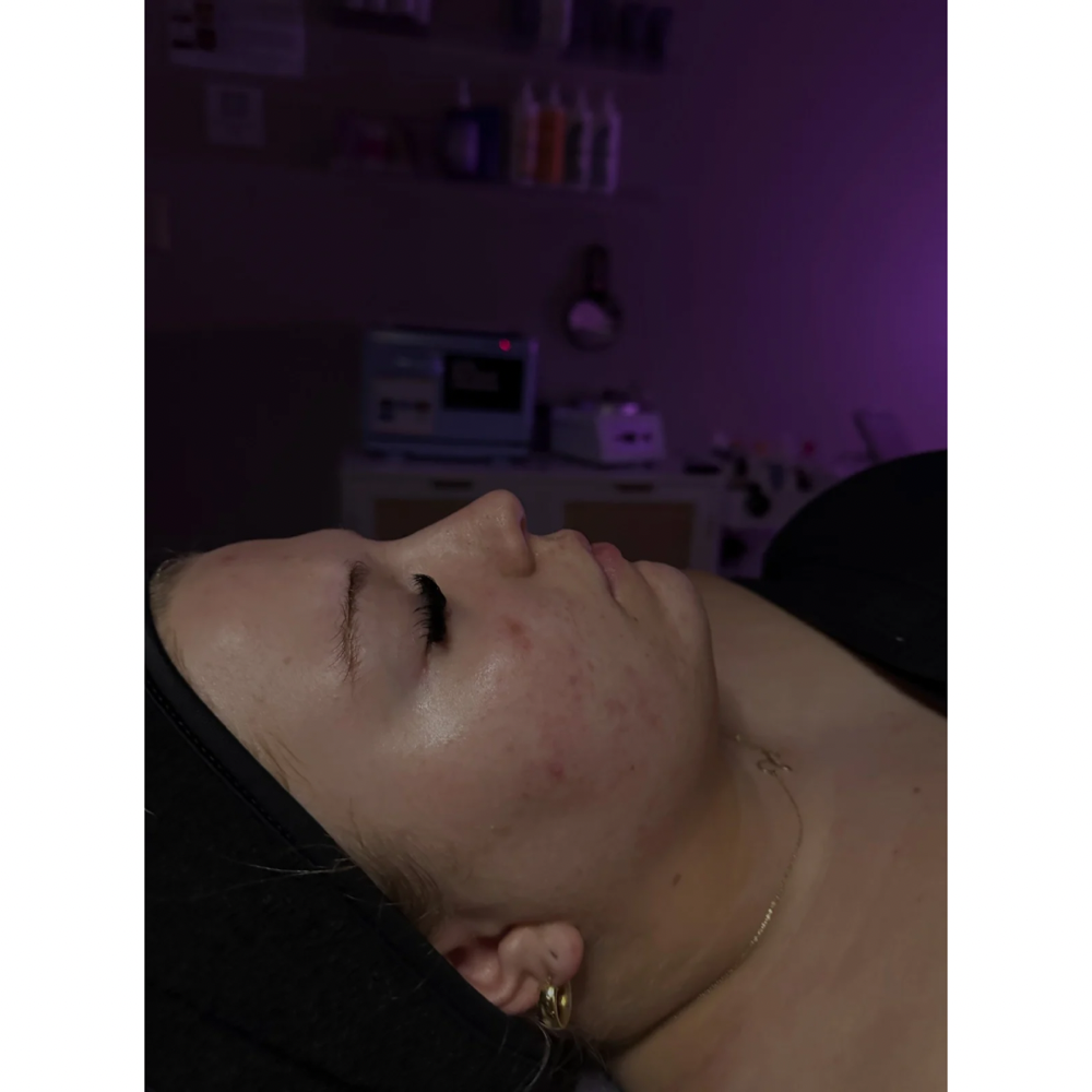 acne bootcamp facial
