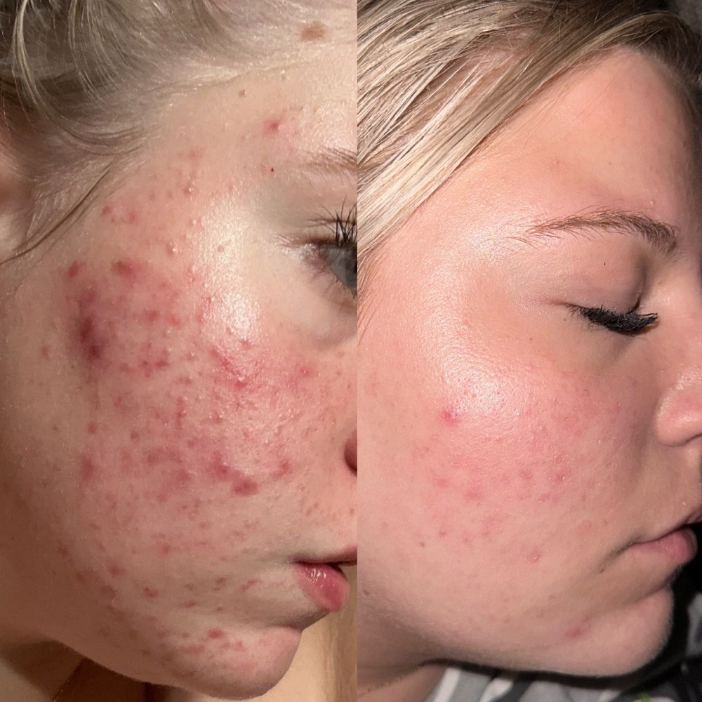 FaceReality Acne Bootcamp Facial