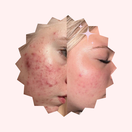 Acne Bootcamp Facial