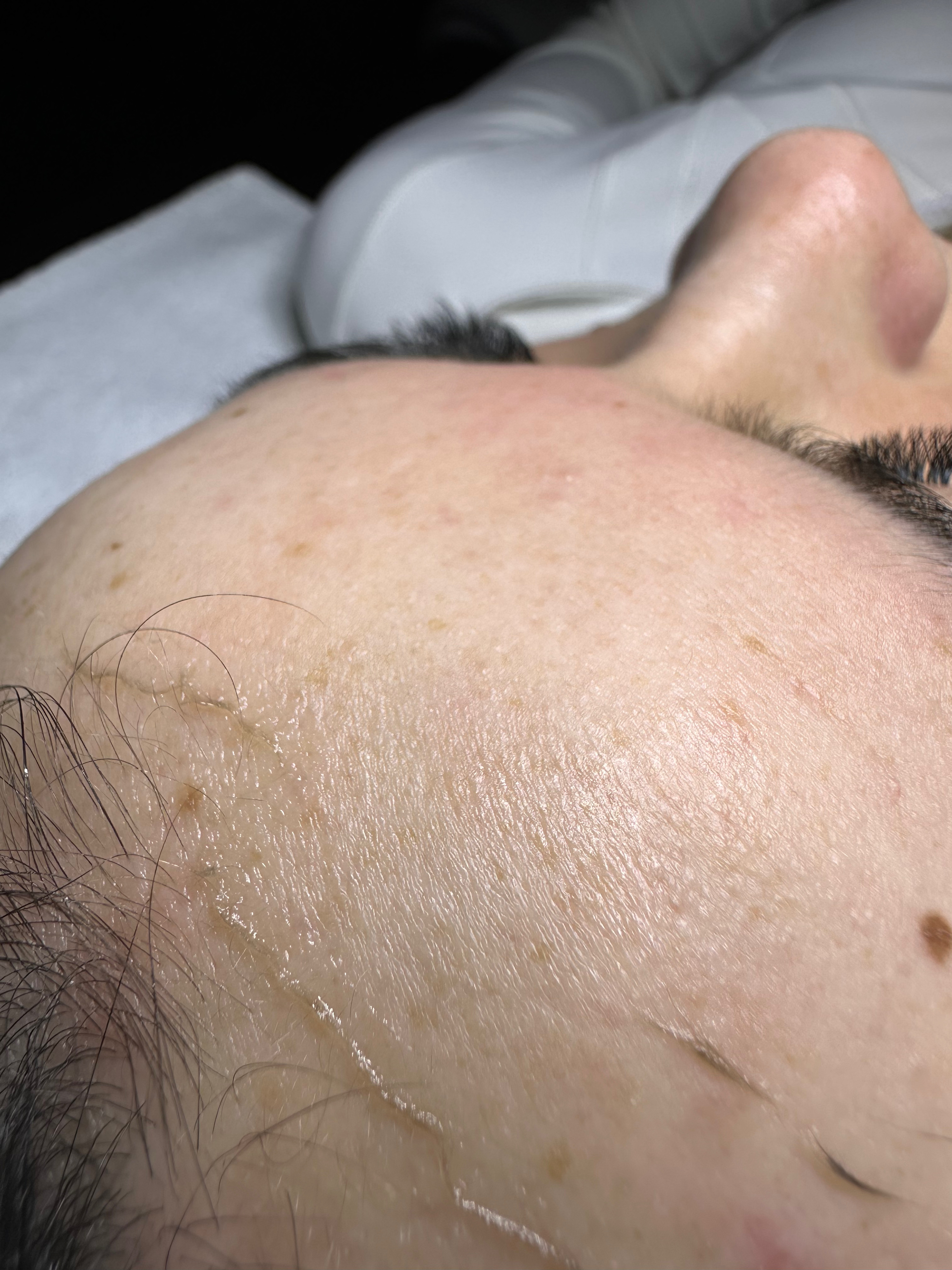 Dermaplaning facial