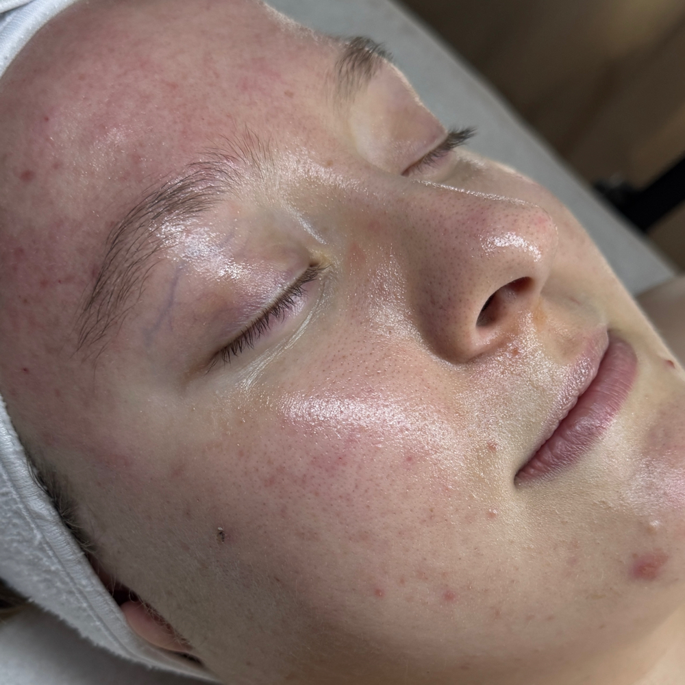 Clarus Reset Acne Reset Program