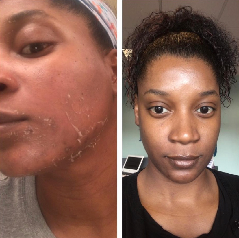 Chemical Peel