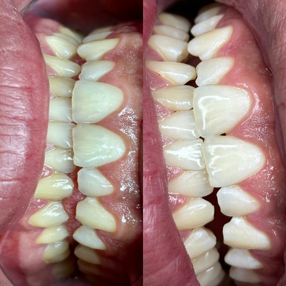 Teeth Whitening 🦷