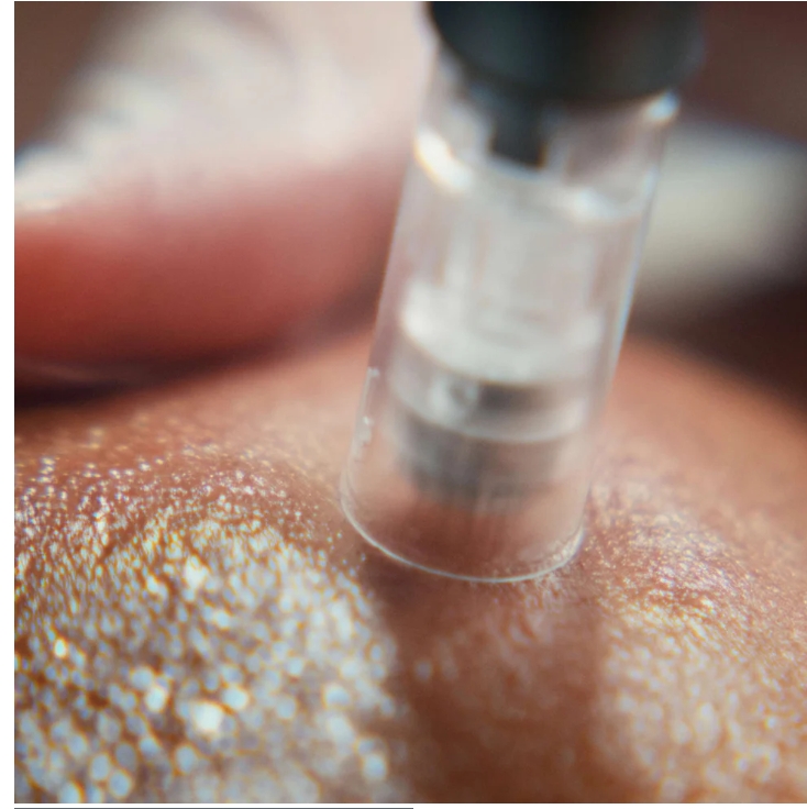 Pro Micro-Needling
