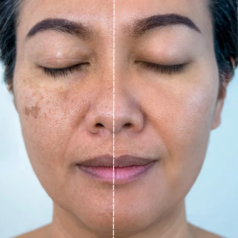 Melasma Yellow Peel