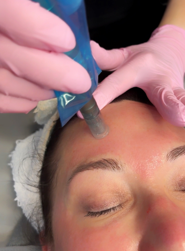 Microneedling facial