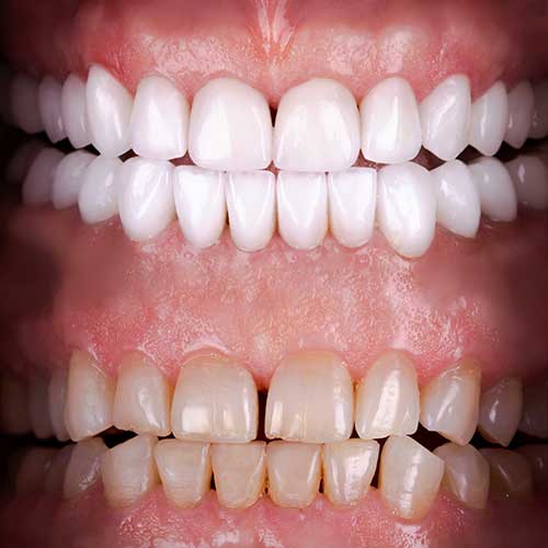 Composite Veneers Consultation at BG Cosmetic in Inglewood, CA