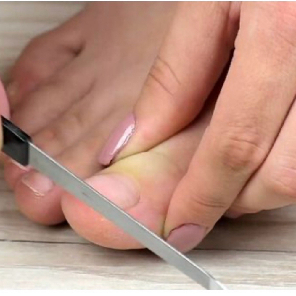 Toe Nail Trim & File at Carbon Foot Lab in Firestone, CO