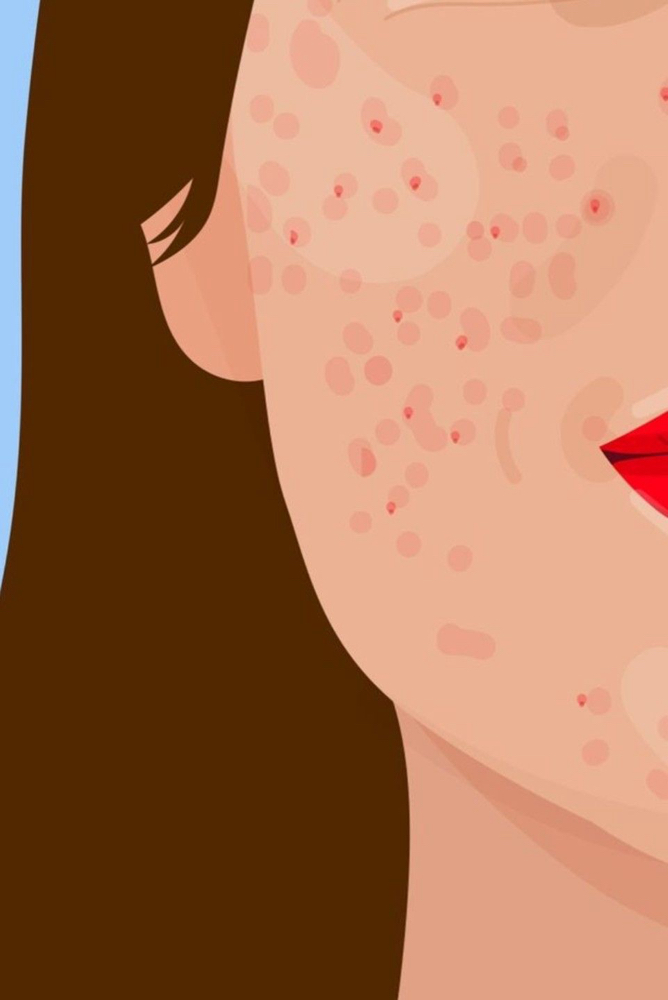 Anti Acne Facial