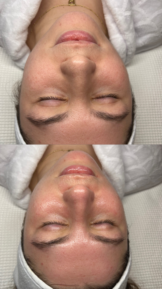 Charcoal Detox Facial (acne)