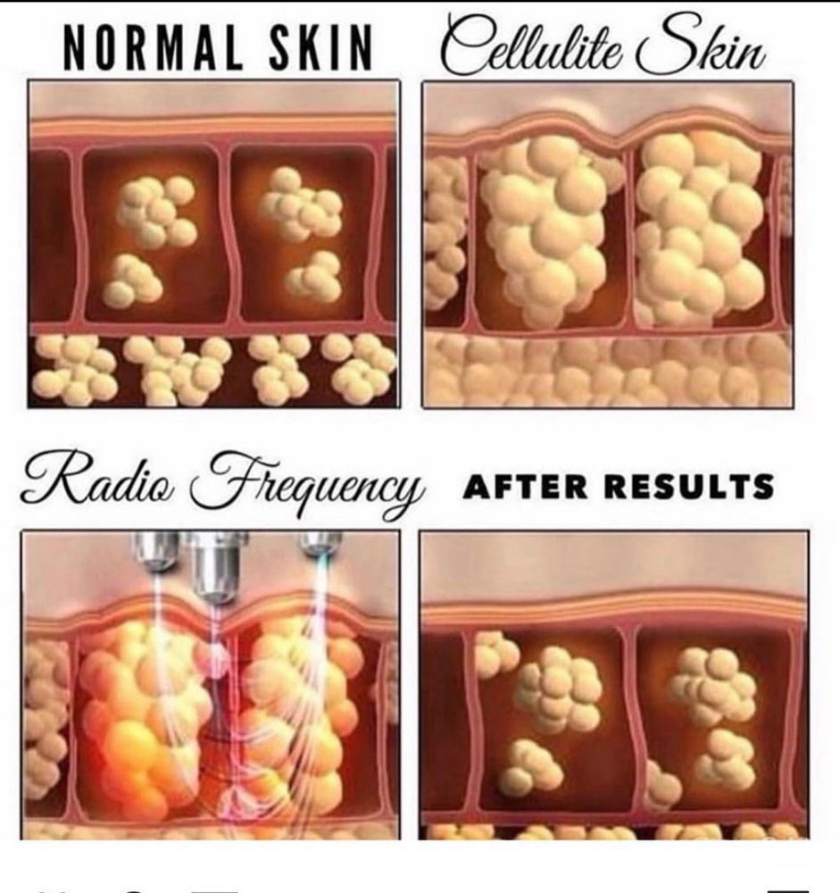 Cellulite removal treatment ONLY