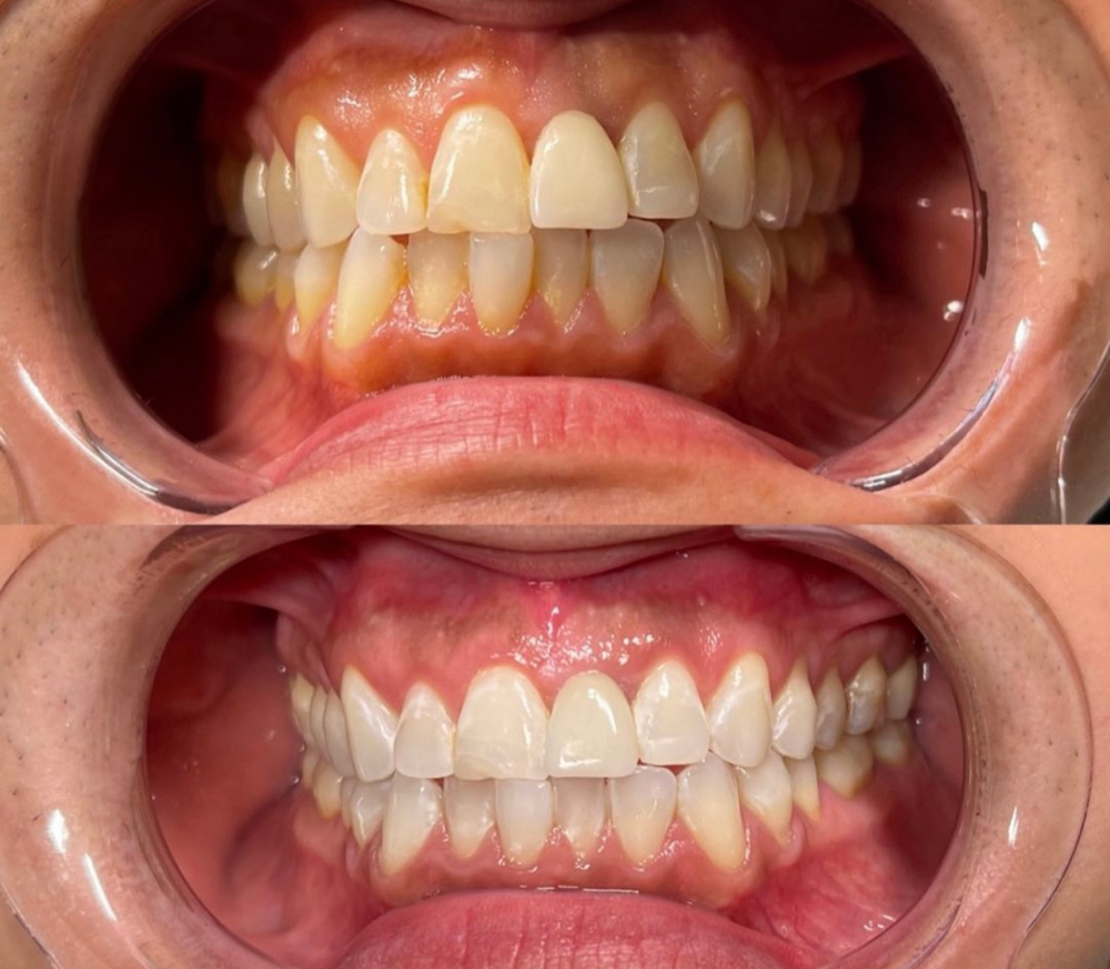 Teeth Whitening