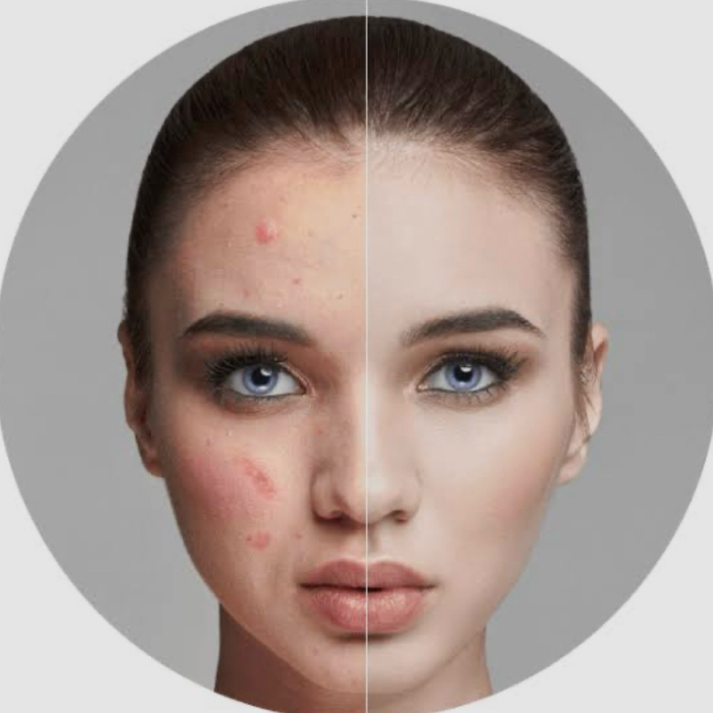 Tratamiento Para Acné at Dream Body Esthetic in Orlando, FL