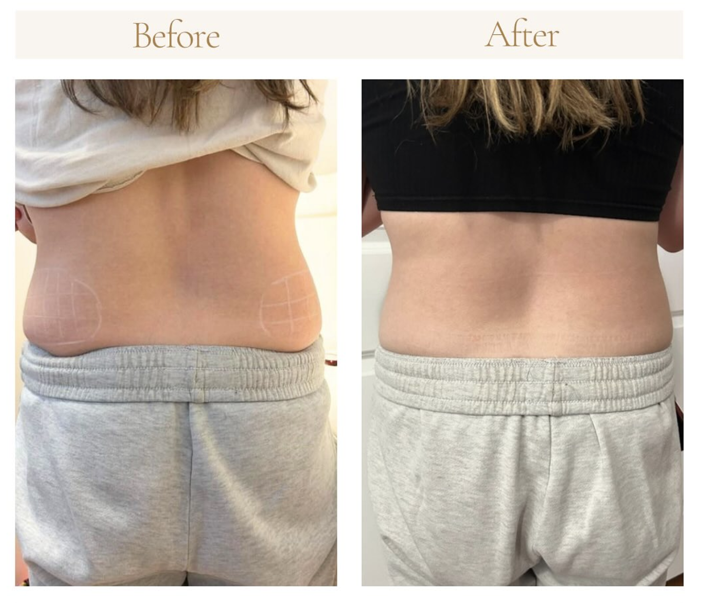 Love Handles - Lipo Dissolve