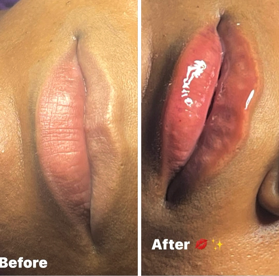 0.3 Hyaluronic Lip Enhancement