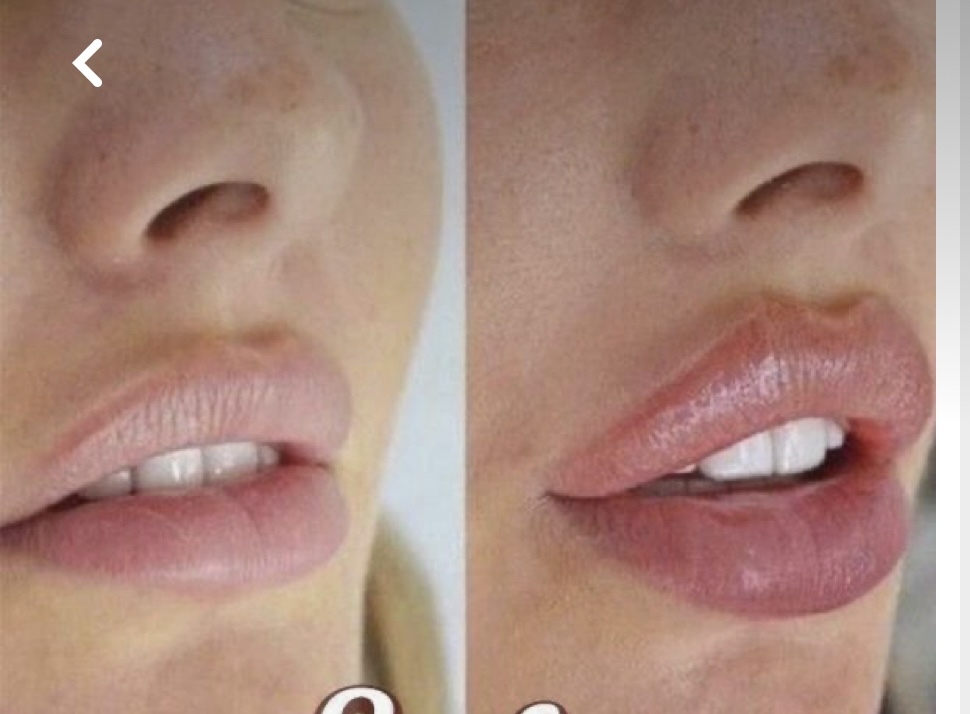 Hyaluronic Acid Lip Enhancement