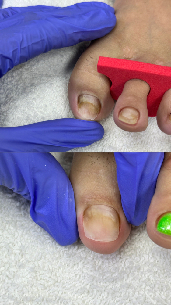 Toe Nail Repair Only