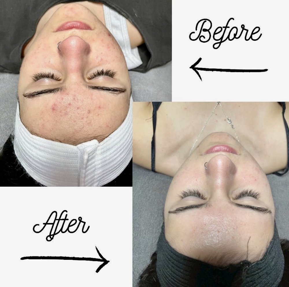 Face Reality Acne Bootcamp FollowUp