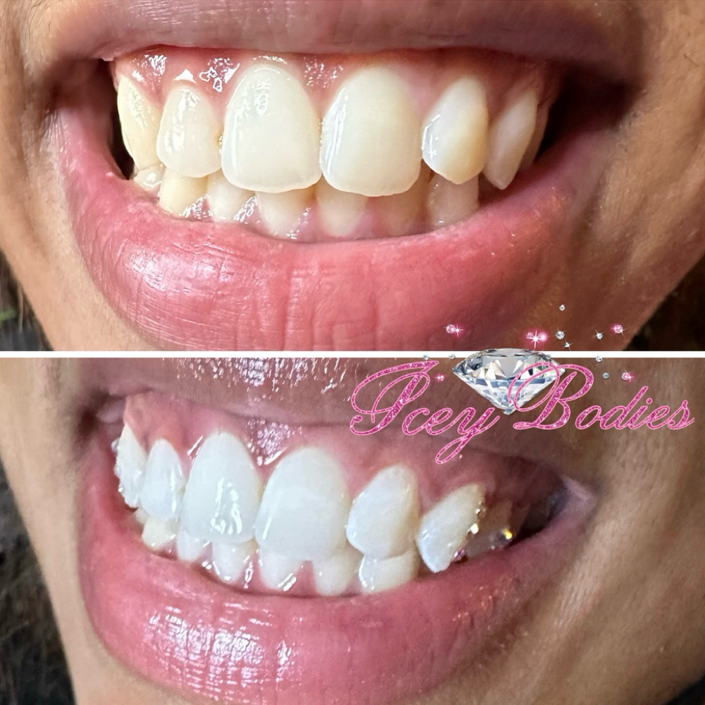 Teeth Whitening Touch Up at Icey Bodies in St Anthony, MN