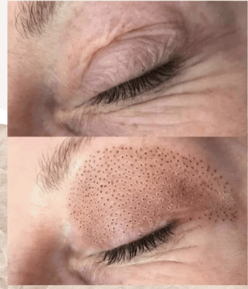 Fibroblast Skin Tightening Series