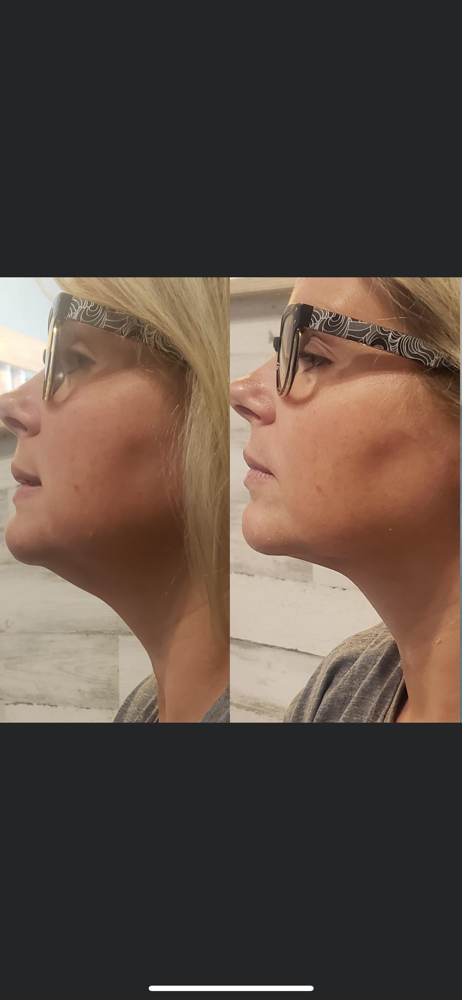 Rf Face (Skin Tightening) at New Glam Aesthetics Studios in Bon Air, VA