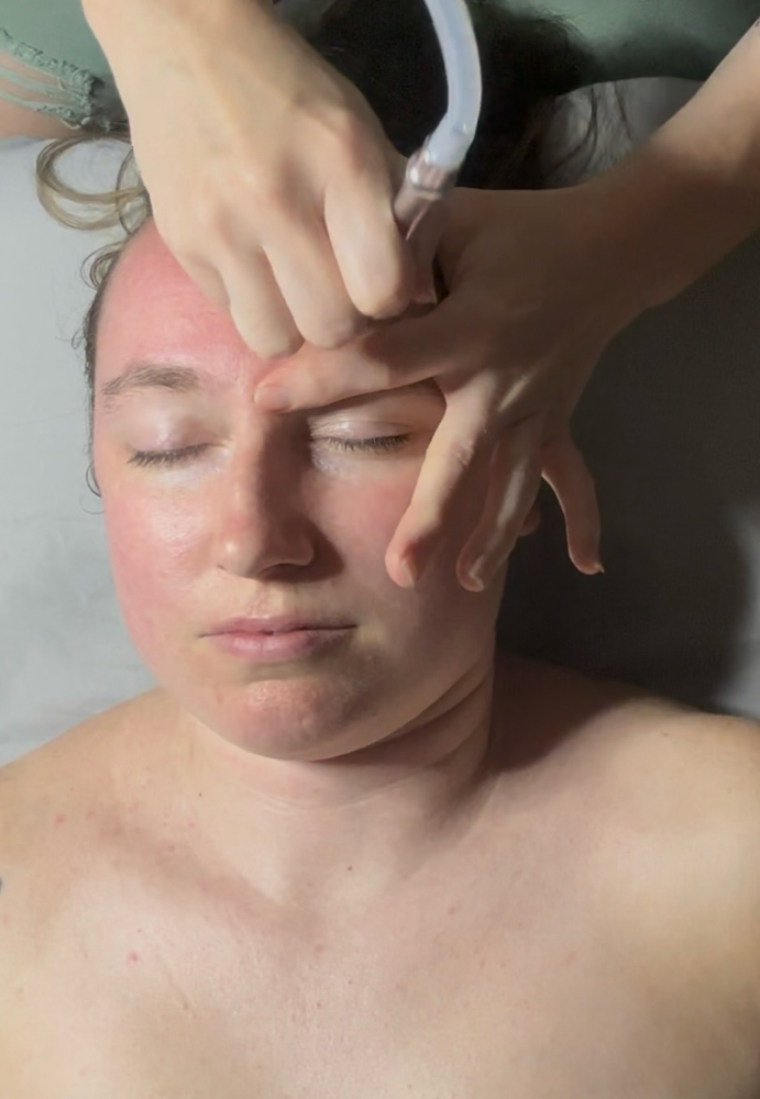Microdermabrasion