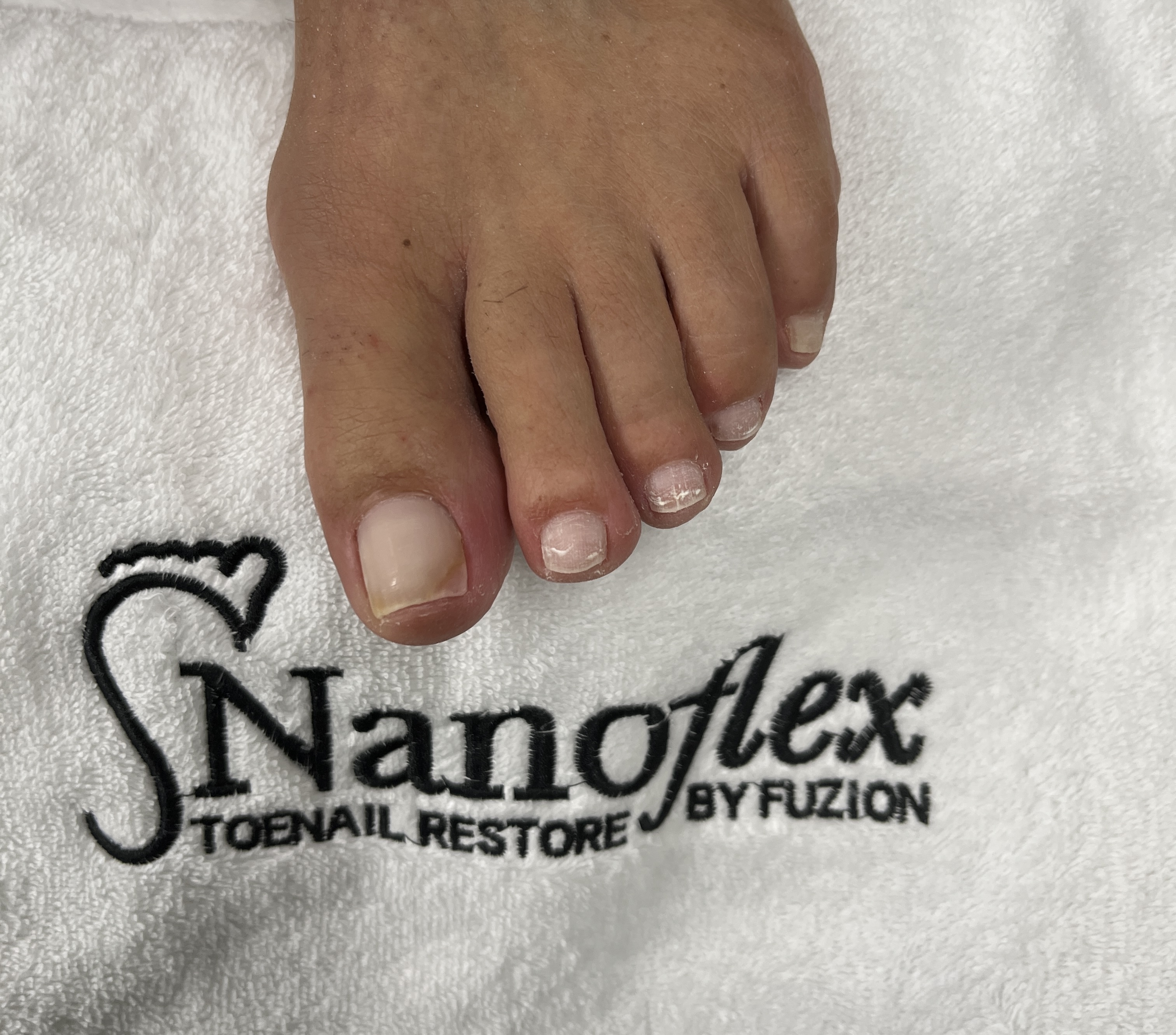 Nanoflex Toenail Reconstruction