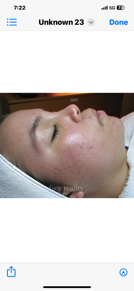 Acne Treatment Express 45 Minute