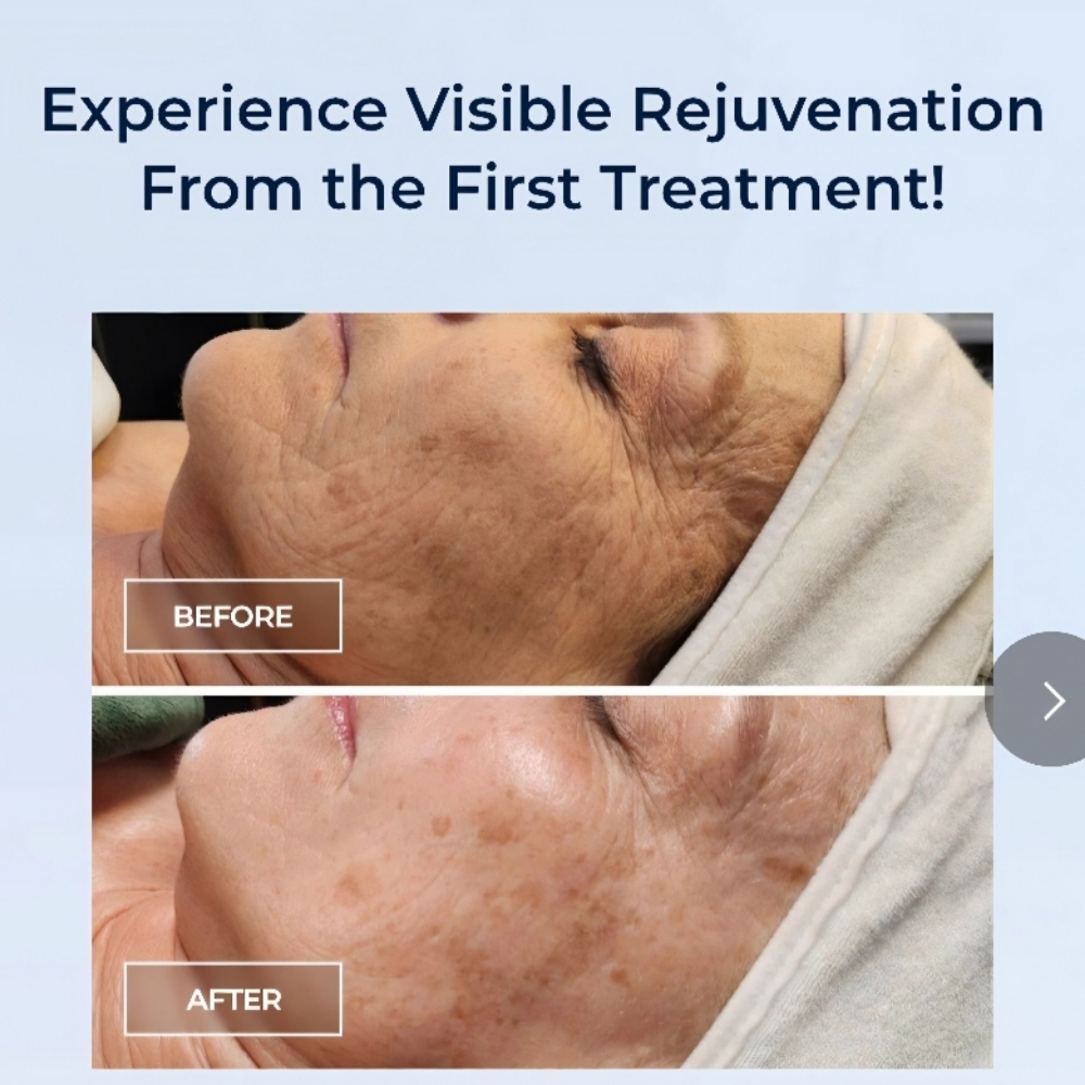 Rejuvenation Facial
