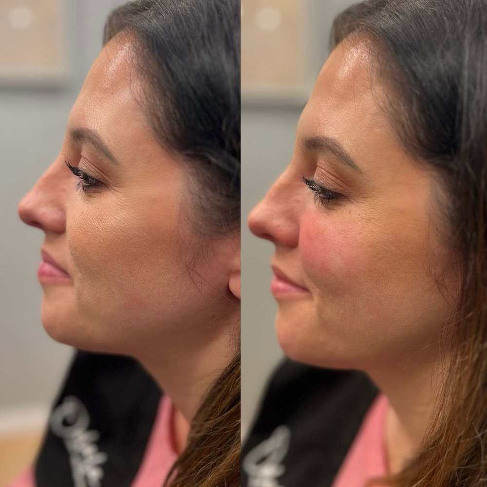 Dermal Filler