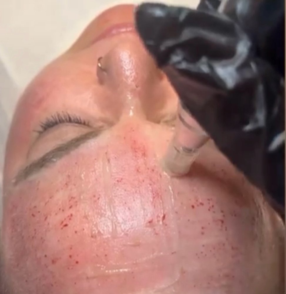 Microneedling with LED Light
