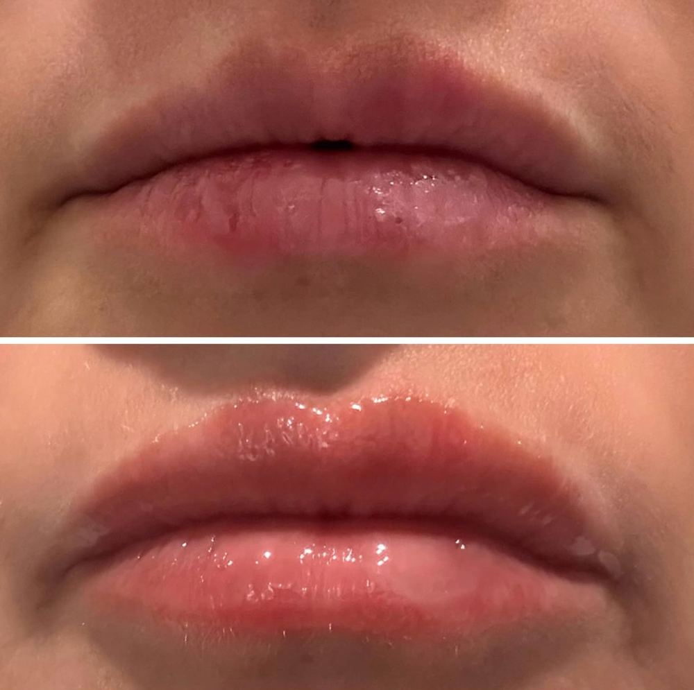 Meso Lip Plump (Needle-less)