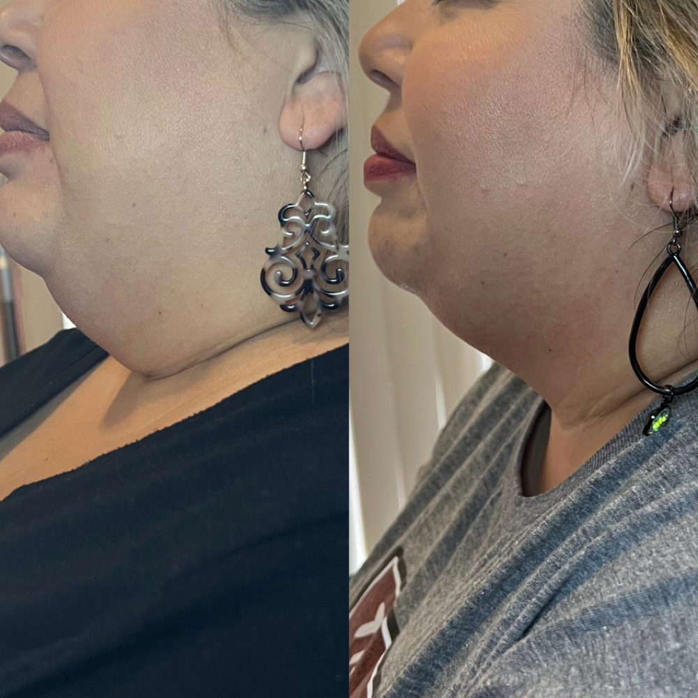 Chin Lipo at BeauTIFFul Modifications in Natalia, TX