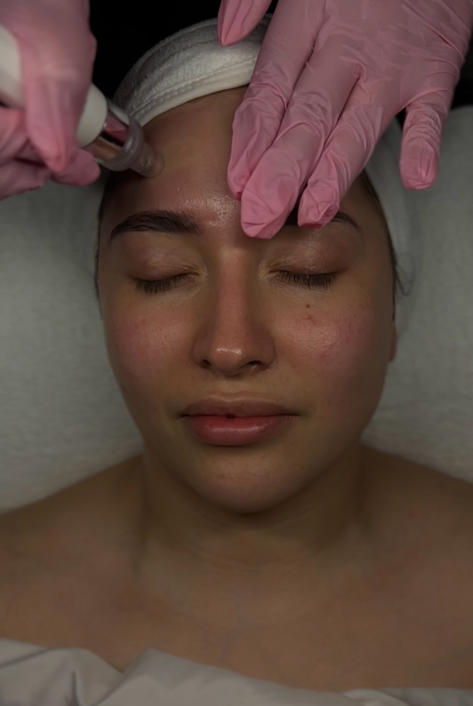 Hydrodermabrasion Facial