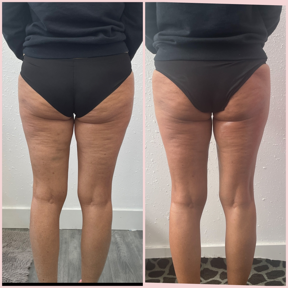 Goodbye cellulite package of 10