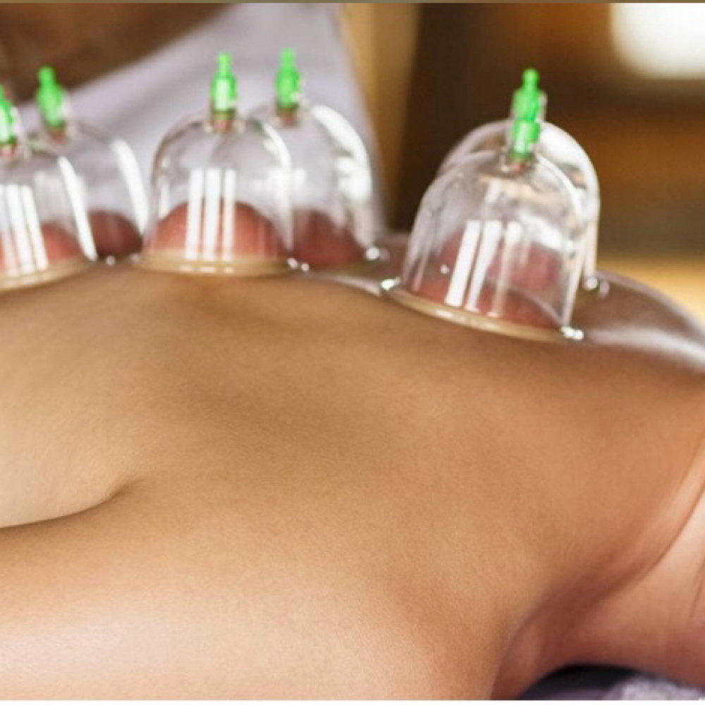 Cupping at Epic Massage in San Tan Valley, AZ