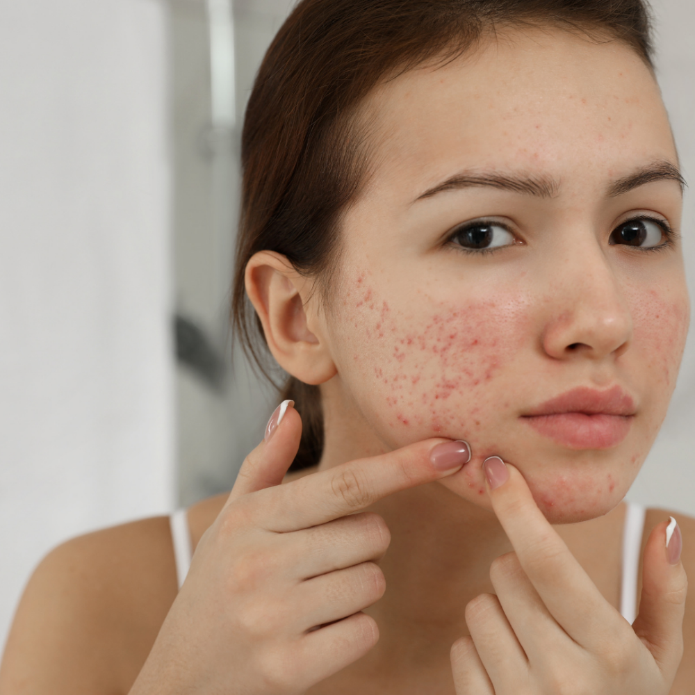 Teen Acne Facial